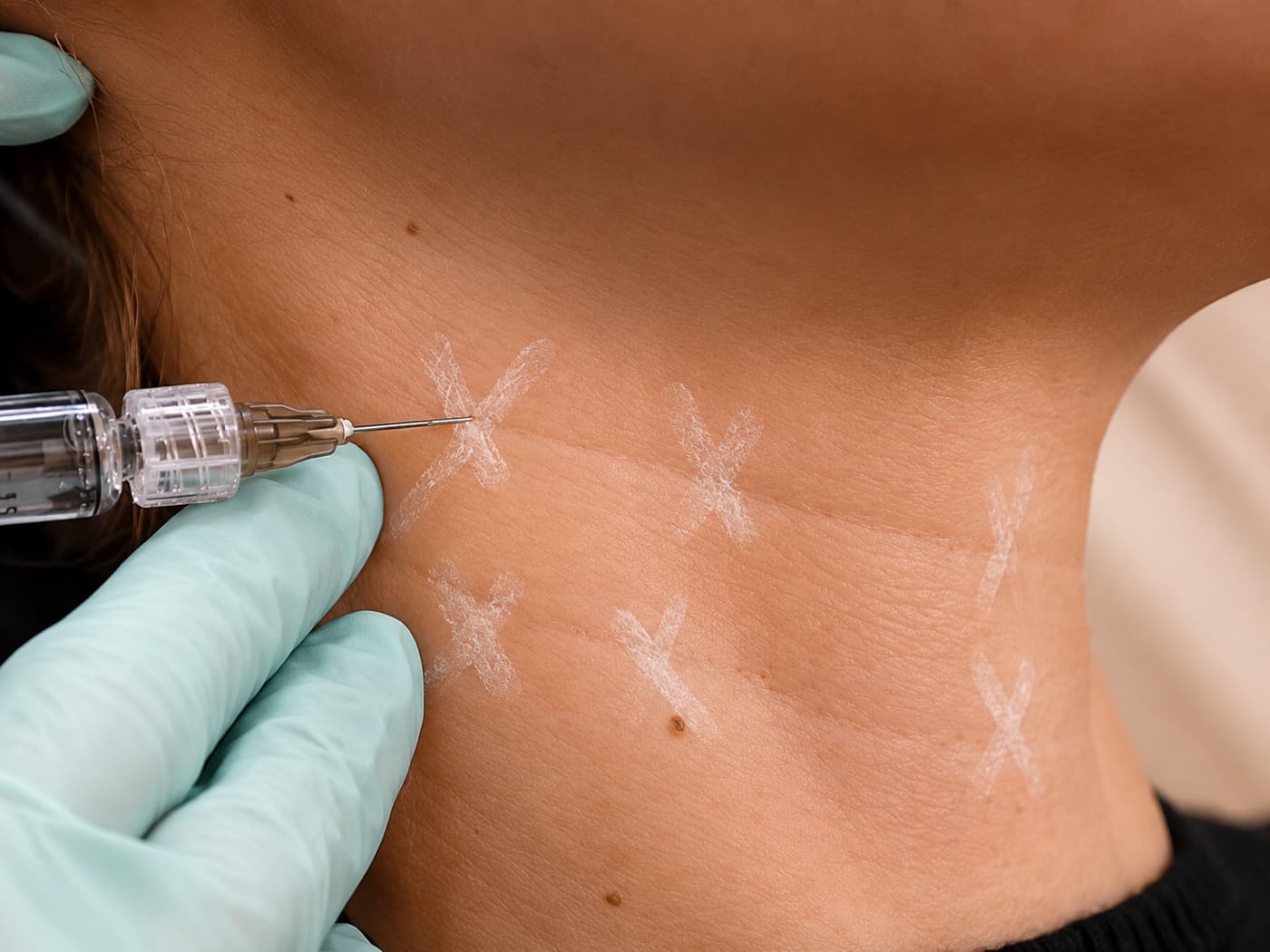 Bioestimulador de Colágeno Pescoço